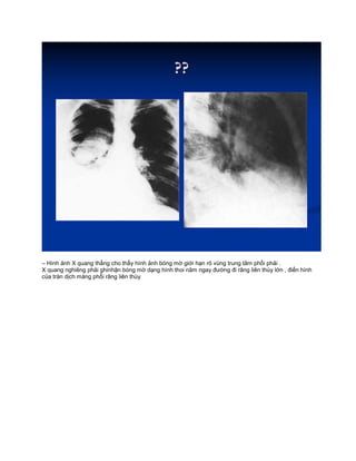 – Hình ảnh X quang thẳng cho thấy hình ảnh bóng mờ giới hạn rõ vùng trung tâm phổi phải .
X quang nghiêng phải ghinhận bóng mờ dạng hình thoi năm ngay đường đi rãng liên thùy lớn , điển hình
của tràn dịch màng phổi rãng liên thùy
 