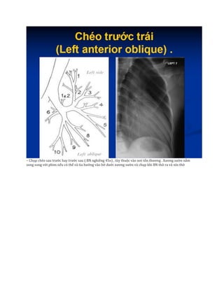 – Chụp chéo sau trước hay trước sau ( BN nghiêng 45o) , tùy thuộc vào nơi tổn thương . Xương sườn nằm
song song với phim nếu có thể và tia hướng vào bờ dưới xương sườn và chụp khi BN thở ra và nín thở
 
