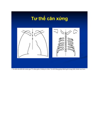 – Tư thế cân đối khi mỏm gai T3 nằm giữa 2 khớp ức đòn. Tư thế đúng giúp đánh giá trung thất chính xác hơn.
 