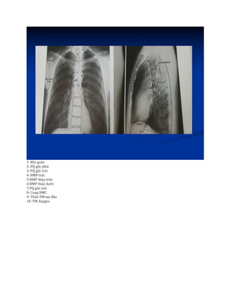 1: Khí quản
2: PQ gốc phải
3: PQ gốc trái
4: ĐMP trái
5:ĐMP thùy trên
6:ĐMP thùy dưới
7:PQ gốc trái
8: Cung ĐMC
9: Thân TM tay đầu
10 :TM Azygos
 