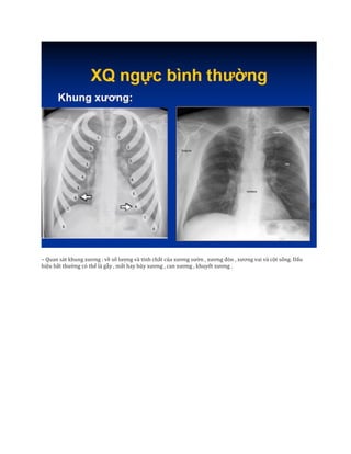 – Quan sát khung xương : về số lượng và tính chất của xương sườn , xương đòn , xương vai và cột sống. Dấu
hiệu bất thường có thể là gẫy , mất hay hũy xương , can xương , khuyết xương .
 