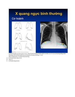 Cơ hoành phải cao hơn trái 2-3 cm . Vòm hoành hướng vể đỉnh phổi và chiều cao 1,5 cm và thường đồng nhất .
Khoảng cách bờ dưới phổi trái và bóng hơi dạ dày thường < 1 cm
Một số hình thái cơ hoành bình thường :
A. Cơ hoành hình mép vỏ sò
B. mép cơ
C. cơ hoành dạng bướu
 