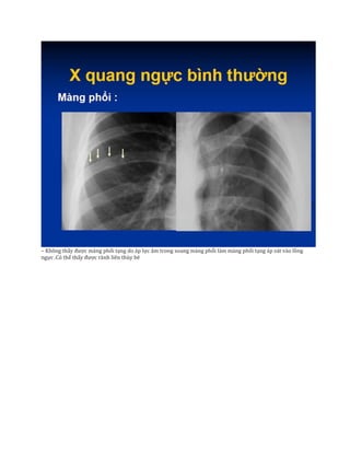 – Không thấy được màng phổi tạng do áp lực âm trong xoang màng phổi làm màng phổi tạng áp sát vào lồng
ngực .Có thể thấy được rãnh liên thùy bé
 