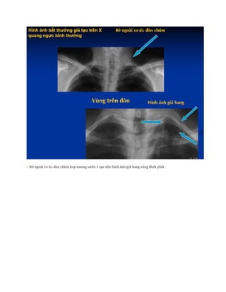 – Bờ ngoài cơ ức đòn chũm hay xương sườn 1 tạo nên hình ảnh giả hang vùng đỉnh phổi .
 