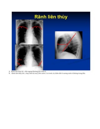 A. Rãnh liên thùy bé : nằm ngang khoảng liên sườn 4
B. Rãnh liên thùy lớn : chạy chéo từ sau ( liên sườn 3 ra trước và chấm dứt ở xương sườn 6 đường trung đòn
 