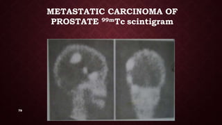 79
METASTATIC CARCINOMA OF
PROSTATE 99mTc scintigram
 