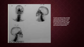 Frontal and lateral (right and left)
radionuclide images of the skull
showing intense activity in the
left temporomandibular joint in a
41-year-old woman with an MRI-
confirmed temporomandibular
joint meniscus dysfunction.
 