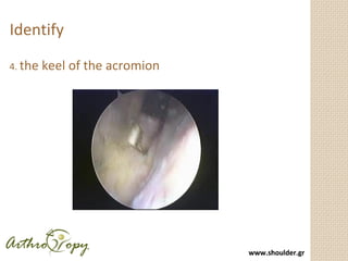 www.shoulder.grwww.shoulder.gr
Recognize the Tear Pattern
Tears must be repaired in the direction of
greatest mobility -> ...