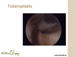 www.shoulder.grwww.shoulder.gr
Arthroscopic repair yields
 90-95% excellent in small and medium size tears at 4 to
10 yea...