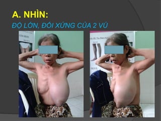 A. NHÌN:
ĐỘ LỚN, ĐỐI XỨNG CỦA 2 VÚ
 