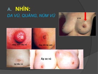 A. NHÌN:
DA VÚ, QUẦNG, NÚM VÚ
Áp xe vú
 