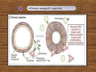 4.Chronic xenograft rejection,
 