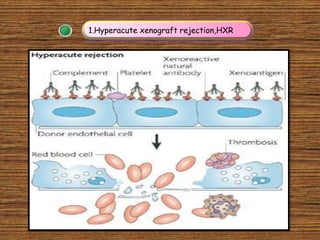 1.Hyperacute xenograft rejection,HXR
 
