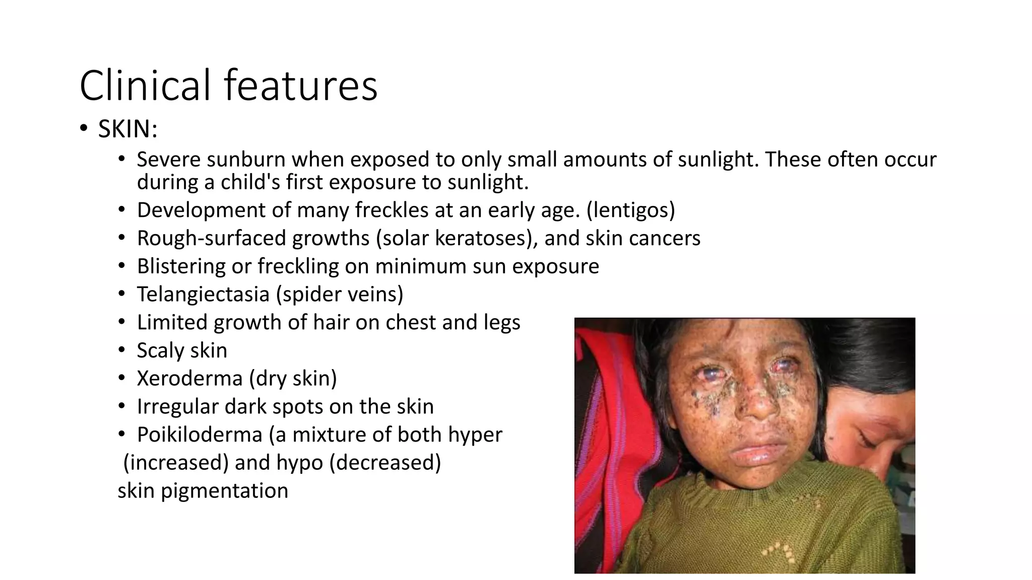 Clinical features
• SKIN:
• Severe sunburn when exposed to only small amounts of sunlight. These often occur
during a child's first exposure to sunlight.
• Development of many freckles at an early age. (lentigos)
• Rough-surfaced growths (solar keratoses), and skin cancers
• Blistering or freckling on minimum sun exposure
• Telangiectasia (spider veins)
• Limited growth of hair on chest and legs
• Scaly skin
• Xeroderma (dry skin)
• Irregular dark spots on the skin
• Poikiloderma (a mixture of both hyper
(increased) and hypo (decreased)
skin pigmentation
 