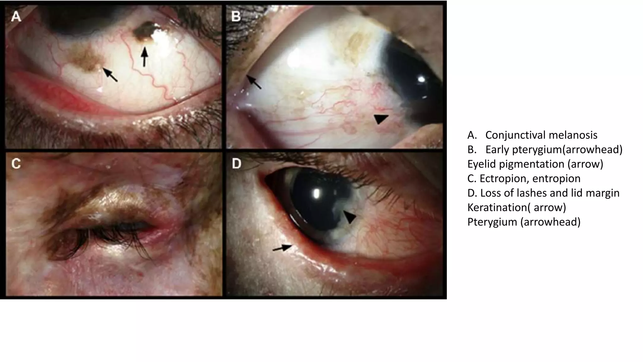 A. Conjunctival melanosis
B. Early pterygium(arrowhead)
Eyelid pigmentation (arrow)
C. Ectropion, entropion
D. Loss of lashes and lid margin
Keratination( arrow)
Pterygium (arrowhead)
 