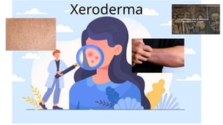 xerodermia ..........................(1).pptx