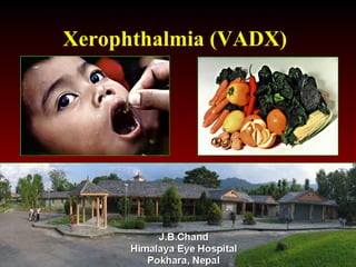 June 28, 2014 VADX JBC 1
Xerophthalmia (VADX)
 