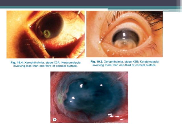 xerophthalmia-pptx