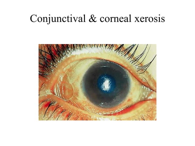 xerophthalmia-pptx-eye-and-vision-conditions-diseases-and-conditions