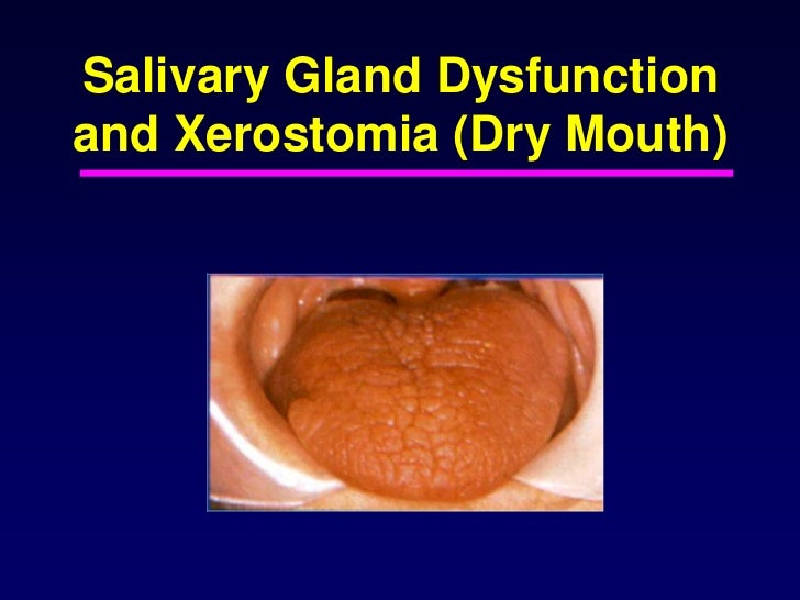 Xerostomia