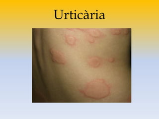 Urticària
 