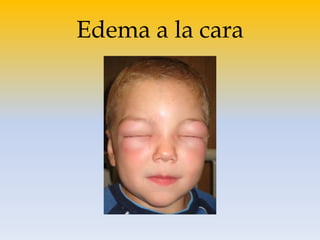 Edema a la cara
 
