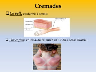 Cremades
La pell: epidermis i dermis
 Primer grau: eritema, dolor, curen en 3-7 dies, sense cicatriu.
 