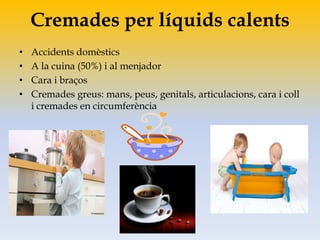 Cremades per líquids calents
• Accidents domèstics
• A la cuina (50%) i al menjador
• Cara i braços
• Cremades greus: mans, peus, genitals, articulacions, cara i coll
i cremades en circumferència
 