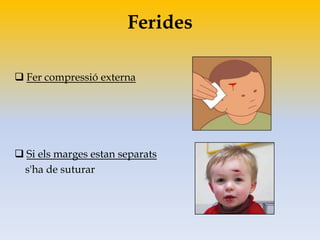 Ferides
 Fer compressió externa
 Si els marges estan separats
s'ha de suturar
 