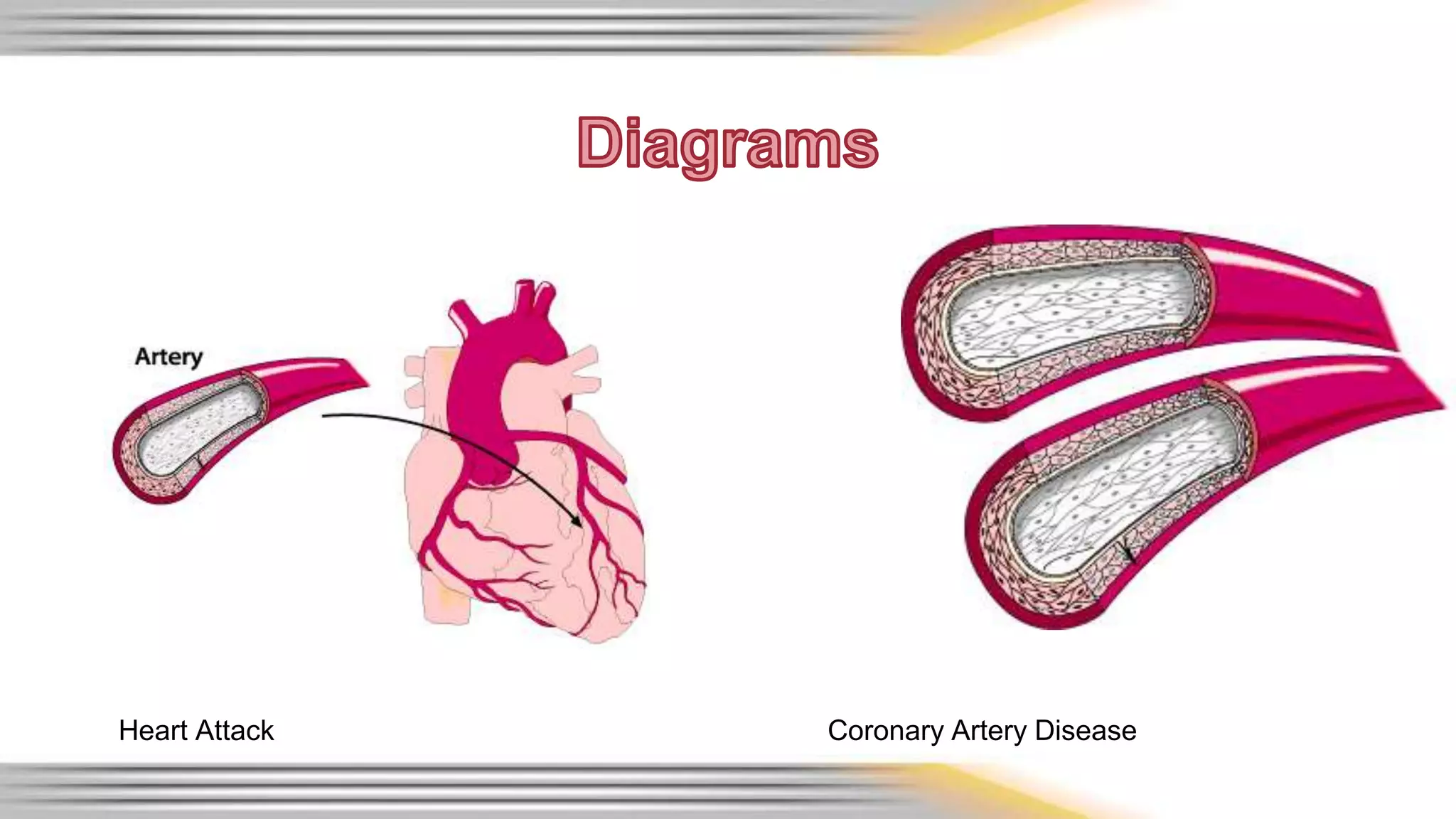 Heart Attack Coronary Artery Disease 
 