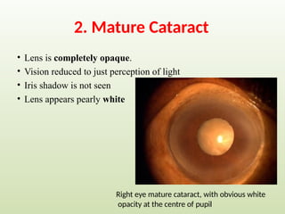 2. Mature Cataract
• Lens is completely opaque.
• Vision reduced to just perception of light
• Iris shadow is not seen
• Lens appears pearly white
Right eye mature cataract, with obvious white
opacity at the centre of pupil
 