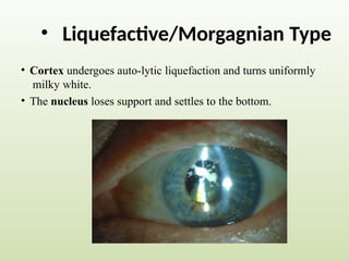 • Liquefactive/Morgagnian Type
• Cortex undergoes auto-lytic liquefaction and turns uniformly
milky white.
• The nucleus loses support and settles to the bottom.
 