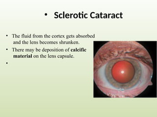 • Sclerotic Cataract
•
•
•
The fluid from the cortex gets absorbed
and the lens becomes shrunken.
There may be deposition of calcific
material on the lens capsule.
 