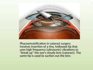 Phacoemulsification in cataract surgery
involves insertion of a tiny, hollowed tip that
uses high frequency (ultrasonic) vibrations to
"break up" the eye's cloudy lens (cataract). The
same tip is used to suction out the lens
.
 