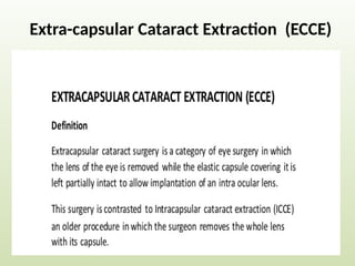 Extra-capsular Cataract Extraction (ECCE)
 