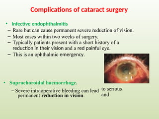 Complications of cataract surgery
• Infective endophthalmitis
– Rare but can cause permanent severe reduction of vision.
– Most cases within two weeks of surgery.
– Typically patients present with a short history of a
reduction in their vision and a red painful eye.
– This is an ophthalmic emergency.
•
to serious
and
Suprachoroidal haemorrhage.
– Severe intraoperative bleeding can lead
permanent reduction in vision.
 