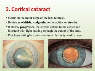 2. Cortical cataract
• Occur on the outer edge of the lens (cortex).
• Begins as whitish, wedge-shaped opacities or streaks.
• It slowly progresses, the streaks extend to the center and
interfere with light passing through the center of the lens.
• Problems with glare are common with this type of cataract.
 