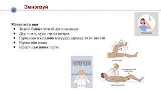 Мэнэнгийн шат
● Толгой байнга хүчтэй лугшиж өвдөх
● Дуу чимээ, хурц гэрэлд цочрох
● Гурвалсан мэдрэлийн цэгүүдэд дарахад эмзэг өвчтэй
● Кернигийн шинж
● Брудзински шинж илрэх
Эмнэлзүй
 