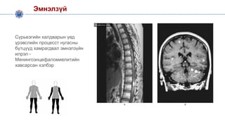 Эмнэлзүй
Сүрьеэгийн халдварын үед
үрэвслийн процесст нугасны
бүтцүүд хамрагдвал эмнэлзүйн
илрэл -
Менингоэнцефаломиелитийн
хавсарсан хэлбэр
 