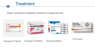 Treatment
Удаан хугацааны өвөрмөц эмчилгээ шаардлагатай.
Хүүхдэд 5-15мг|кг Хүүхдэд 15-20мг|кг Хүүхдэд 30мг|кг
15-25 мг|кг
 