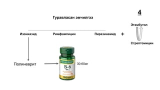 Изониазид Римфампицин Пиразинамид
Гуравласан эмчилгээ
+
Этамбутол
Стрептомицин
4
Полиневрит 30-60мг
 