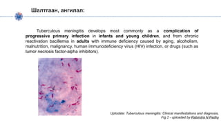 Шалтгаан, ангилал:
Tuberculous meningitis develops most commonly as a complication of
progressive primary infection in infants and young children, and from chronic
reactivation bacillemia in adults with immune deficiency caused by aging, alcoholism,
malnutrition, malignancy, human immunodeficiency virus (HIV) infection, or drugs (such as
tumor necrosis factor-alpha inhibitors).
Uptodate: Tuberculous meningitis: Clinical manifestations and diagnosis,
Fig 2 - uploaded by Rabindra N Padhy
 