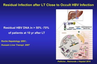 Residual Infection after LT Close to Occult HBV Infection
Pollicino , Raimondo J Hepatol 2014
Residual HBV DNA in > 50% -70%
of patients at 10 yr after LT
Roche Hepatology 2003 ;
Hussain Liver Transpl. 2007
 