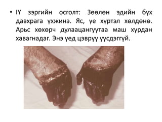 • IY зэргийн осголт: Зөөлөн эдийн бүх
давхрага үхжинэ. Яс, үе хүртэл хөлдөнө.
Арьс хөхөрч дулаацангуутаа маш хурдан
хавагнадаг. Энэ үед цэврүү үүсдэггүй.
 