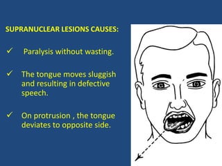 SUPRANUCLEAR LESIONS CAUSES:
 Paralysis without wasting.
 The tongue moves sluggish
and resulting in defective
speech.
 On protrusion , the tongue
deviates to opposite side.
 