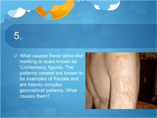 5.
What caused these tattoo-like
marking or scars known as
‘Lichtenberg’ figures. The
patterns created are known to
be examples of fractals and
are heavily complex
geometrical patterns. What
causes them?
 