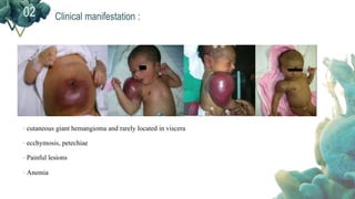 Clinical manifestation :02
- cutaneous giant hemangioma and rarely located in viscera
- ecchymosis, petechiae
- Painful lesions
- Anemia
 