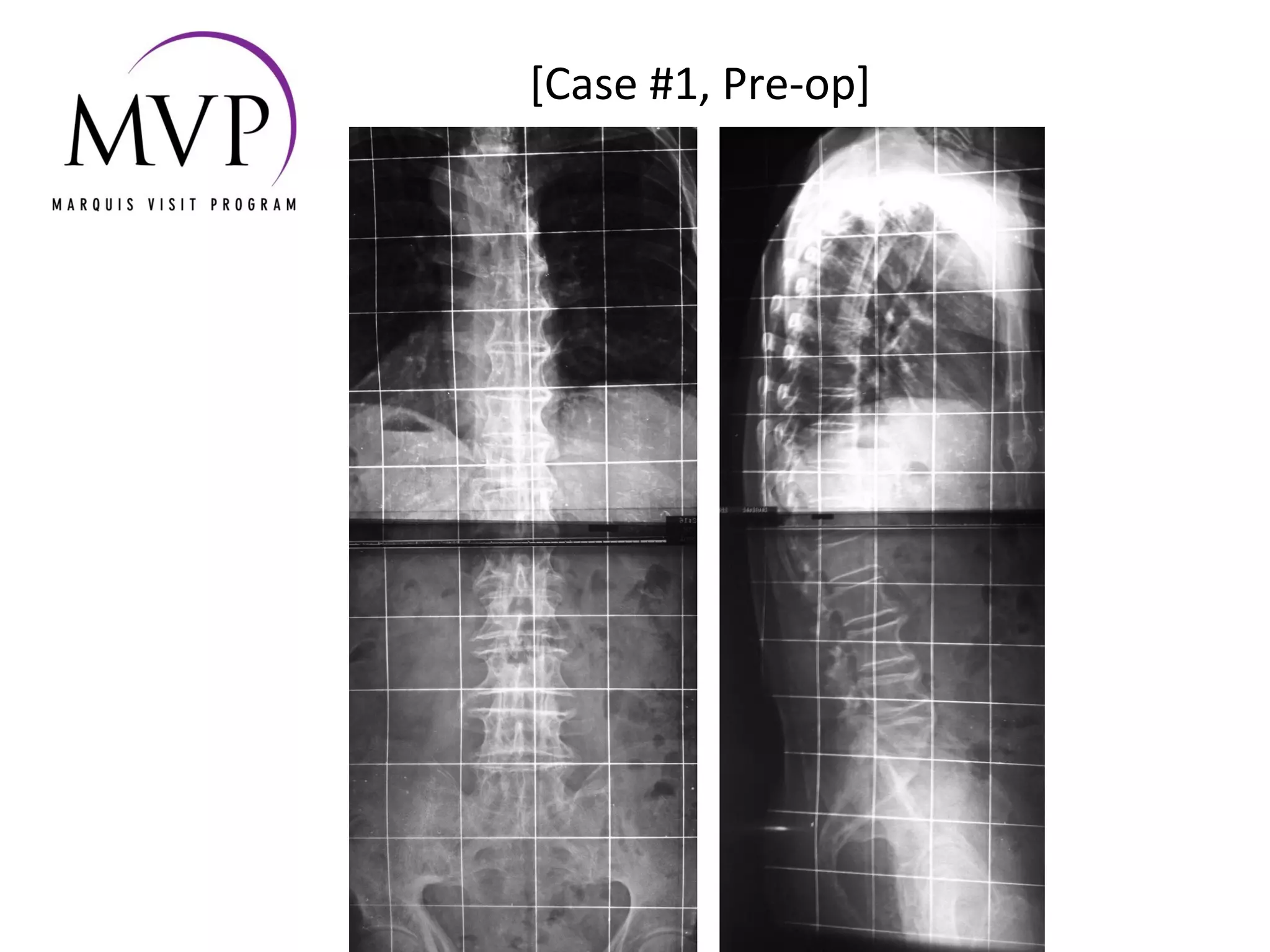 Xlif Case Review | PPT