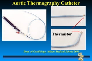 Aortic Thermography CatheterAortic Thermography Catheter
Thermistor
Dept. of Cardiology, Athens Medical School 2001
 