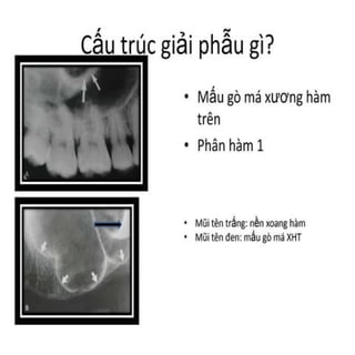 xương ổ răng.pdf